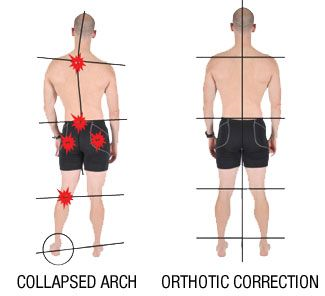 orthotics correct collapsed arches and help reduce pain